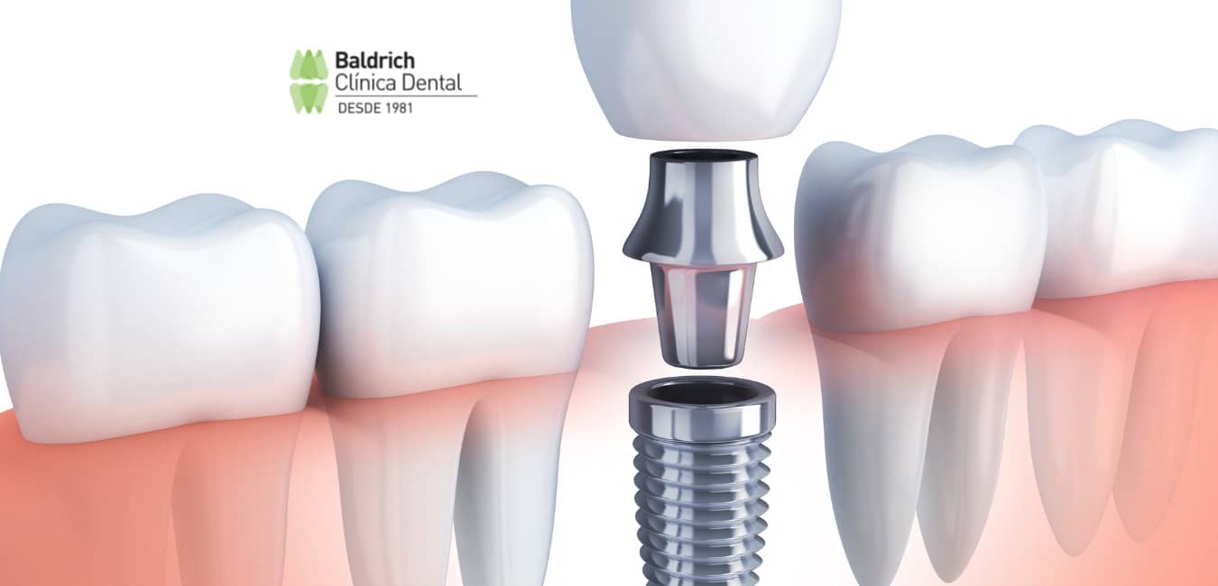 qué es un implante dental