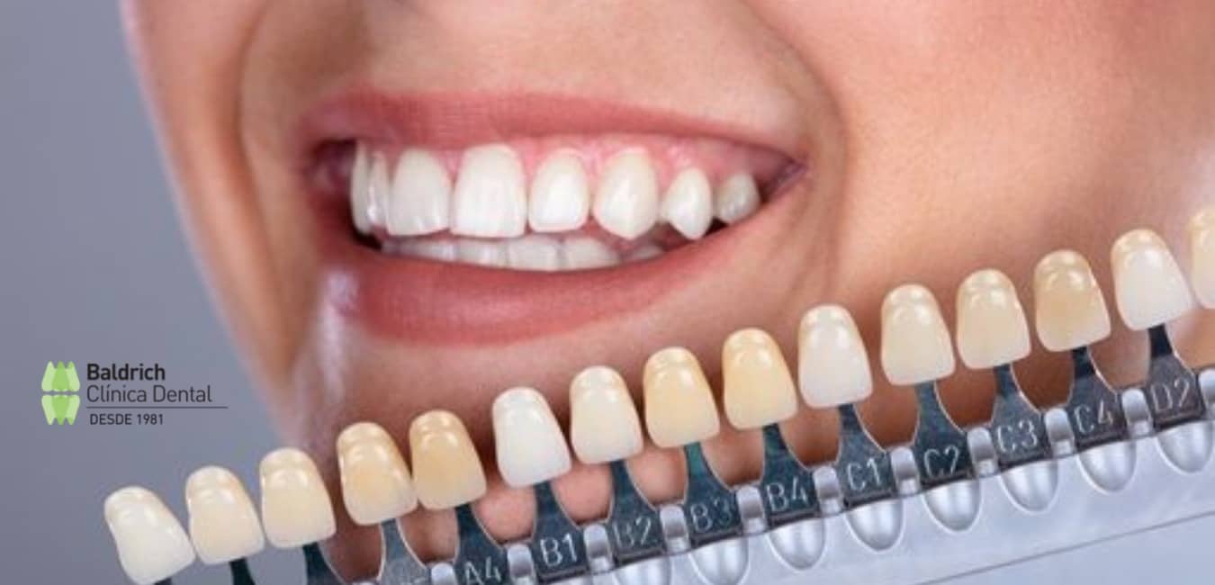 porcelain veneers