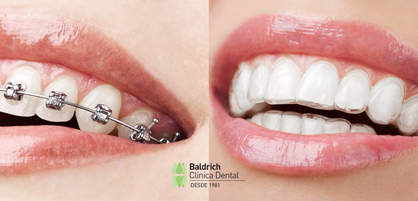 brackets Viladecans