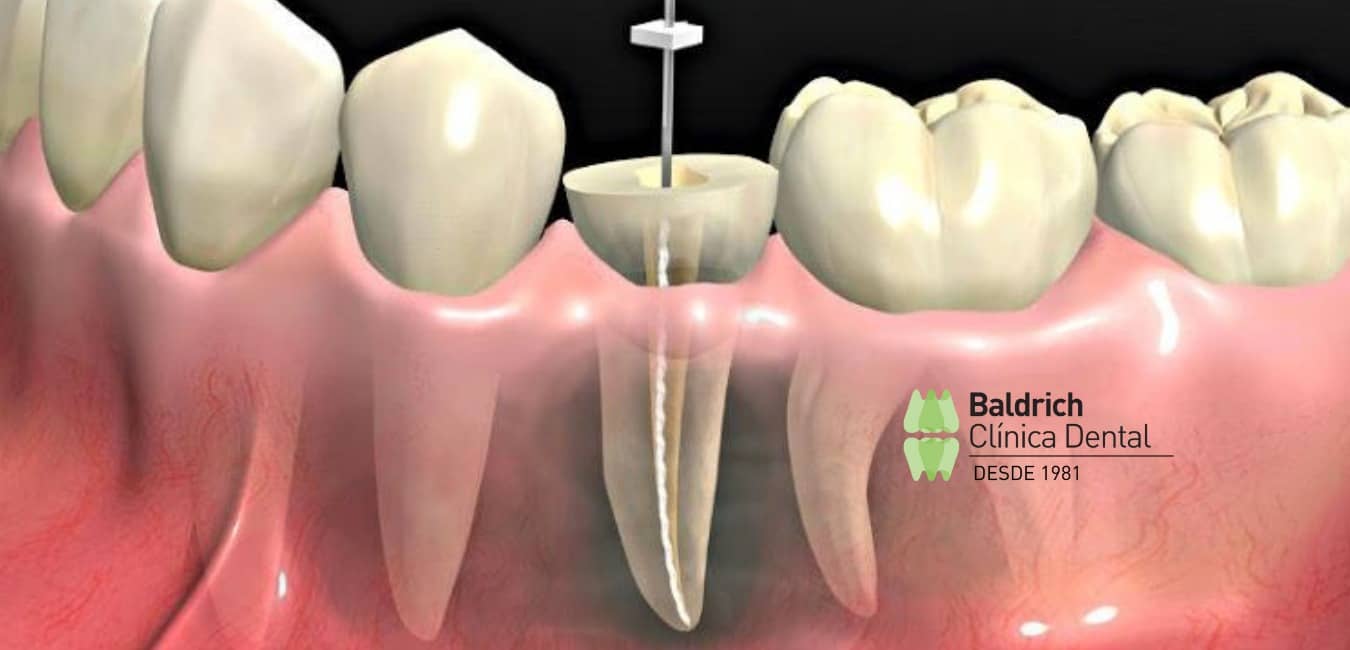 qué es endodoncia