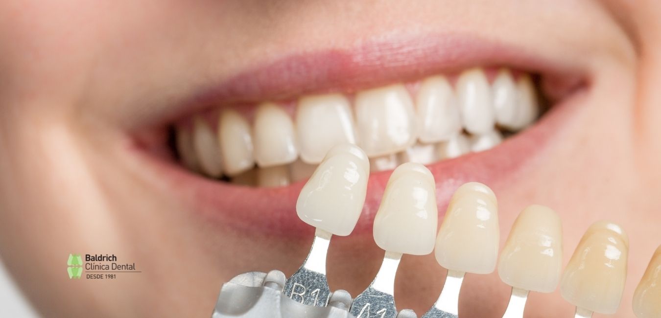 carillas dentales