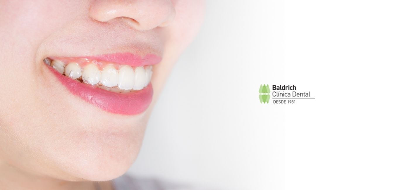 estética dental Invisalign