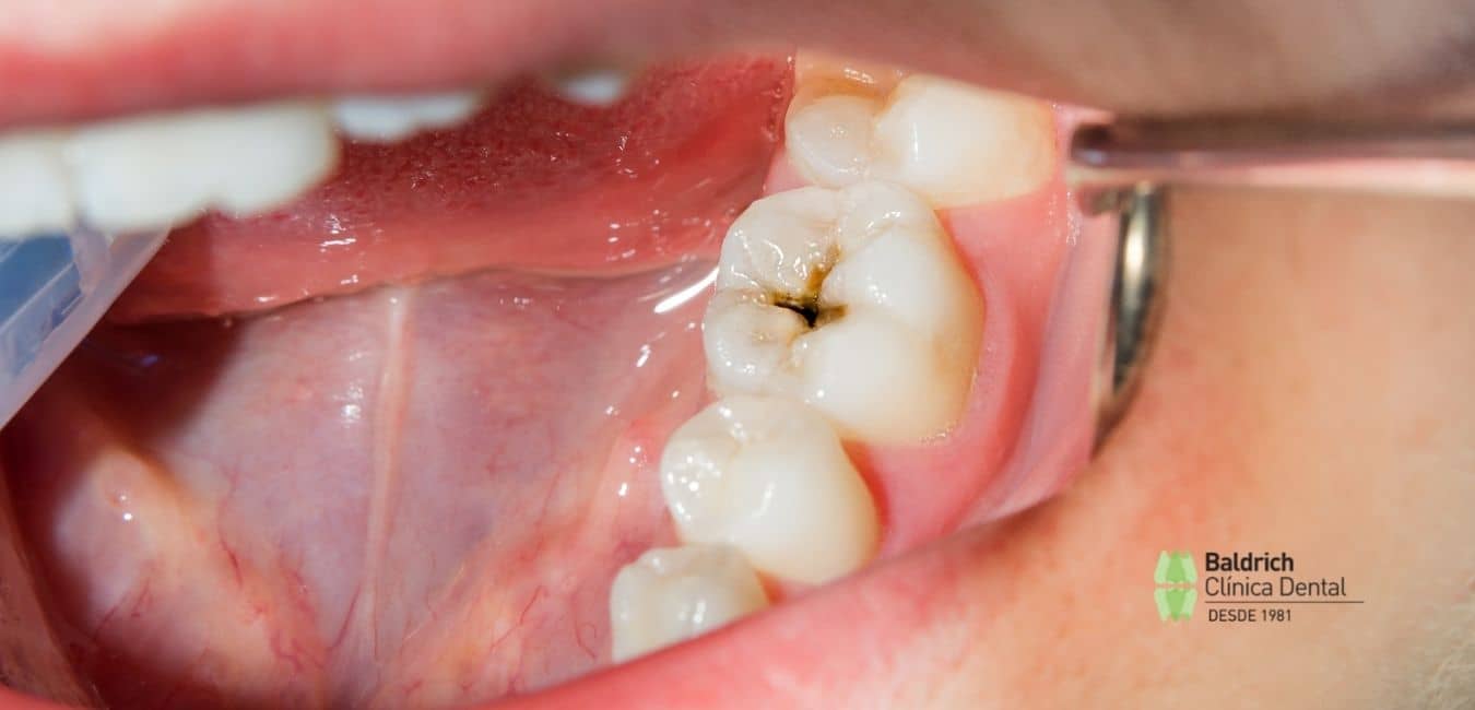 cómo prevenir las caries dentales