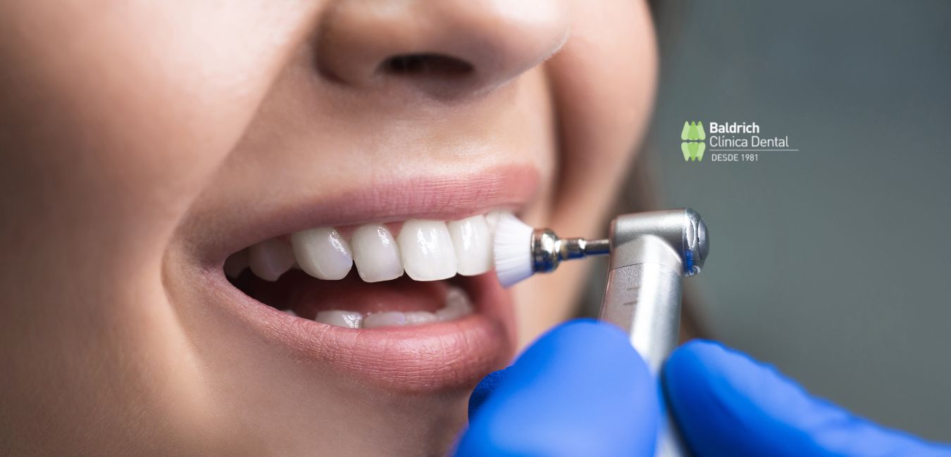 beneficios limpieza dental