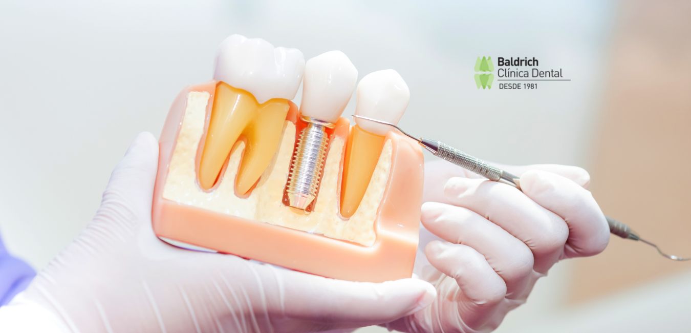 ventajas implante dental