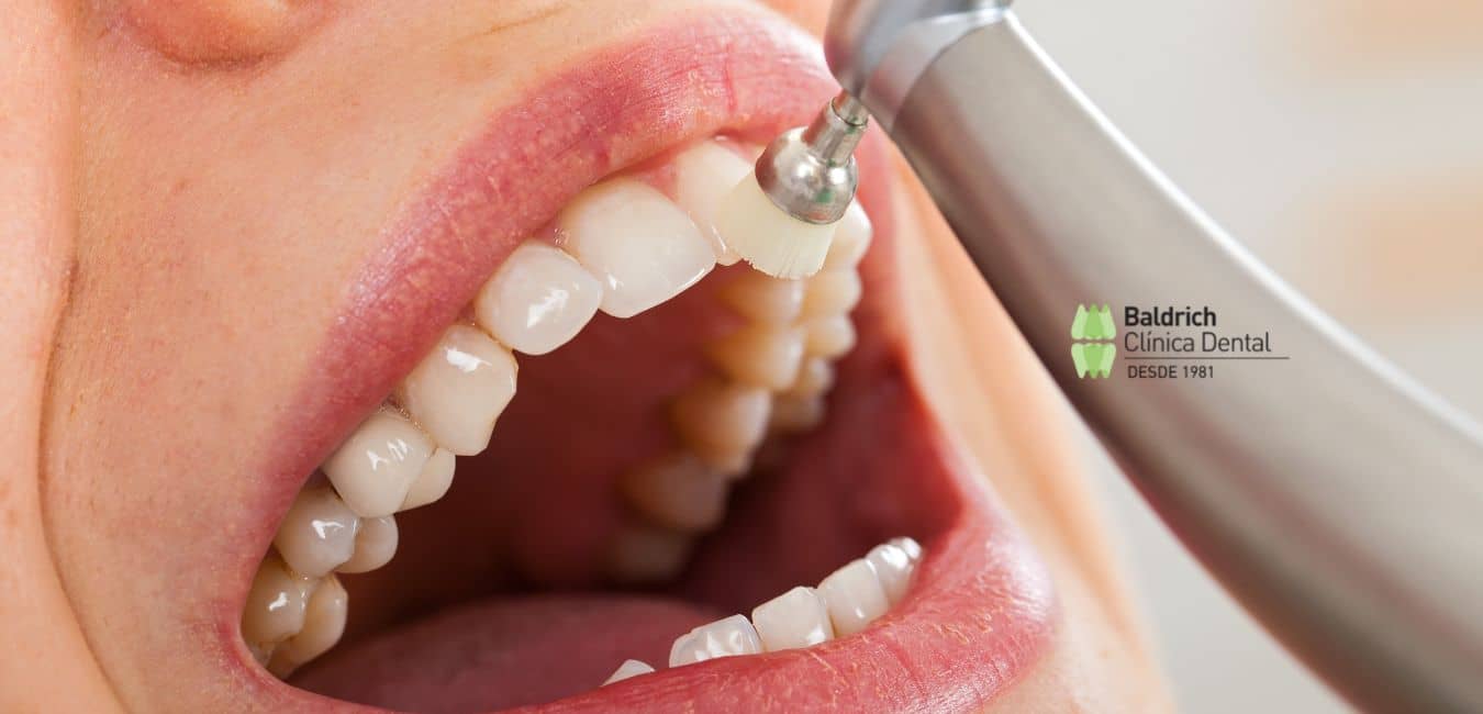 frecuencia limpieza dental