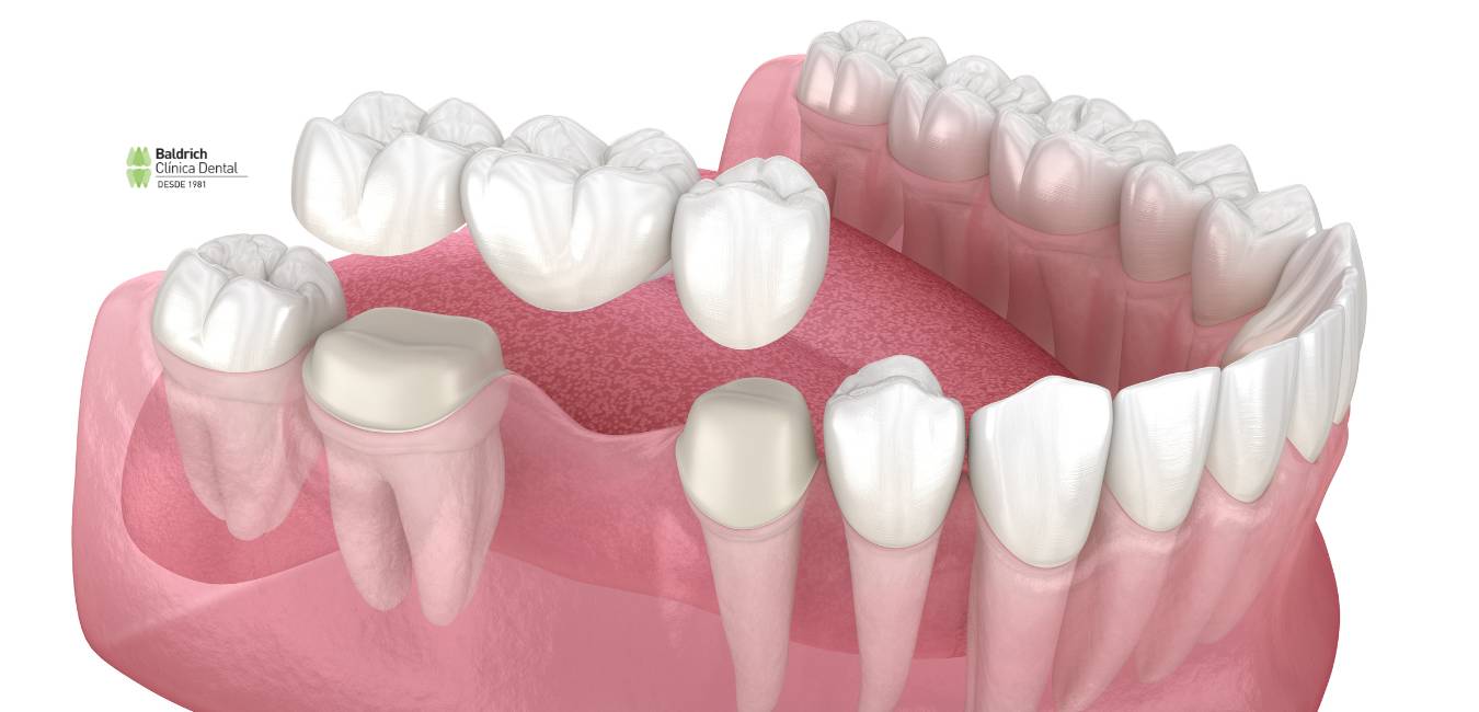 prótesis fija dental