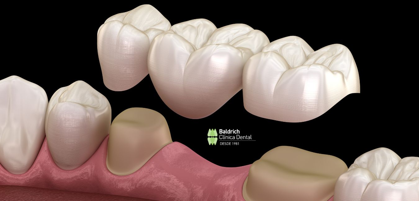 puentes dentales
