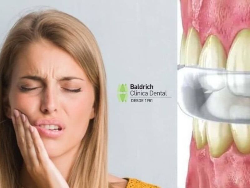 What is bruxism