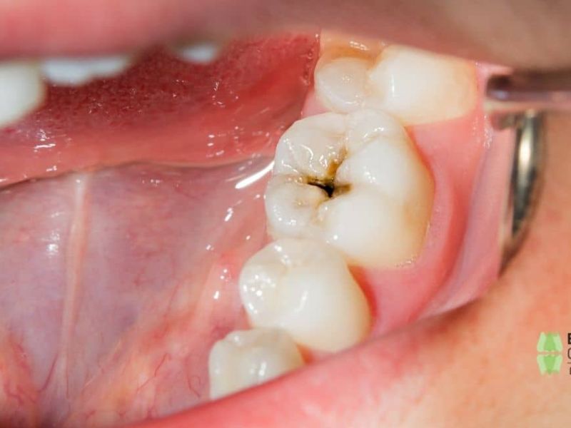 cómo prevenir las caries dentales