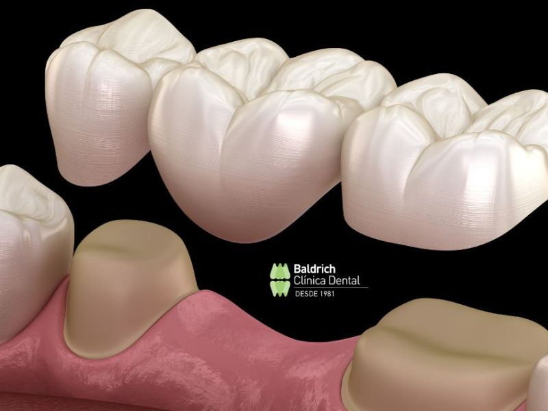 puentes dentales
