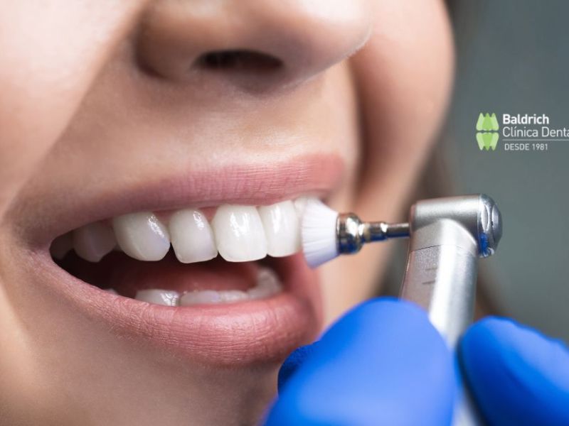 beneficios limpieza dental