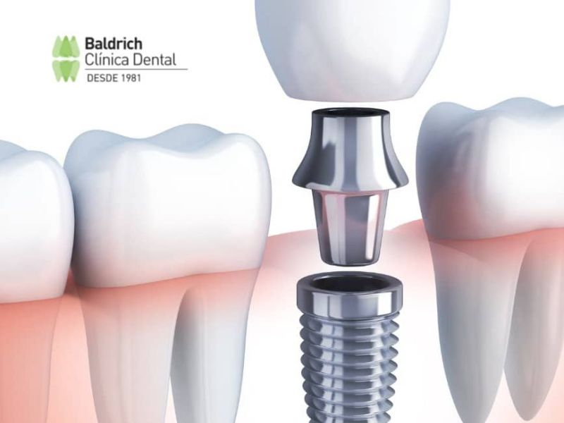 dental implant implante denat