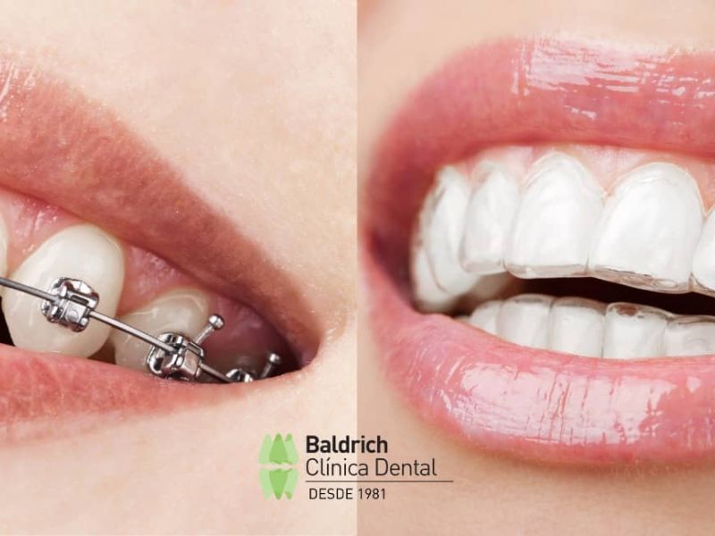Braces vs Invisalign