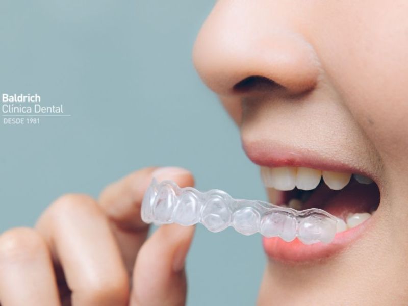 invisalign en Viladecans