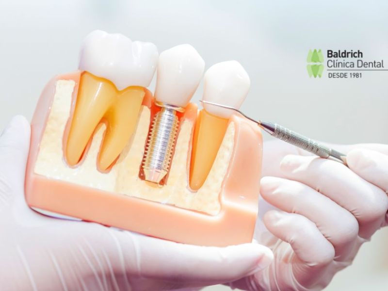 ventajas implante dental