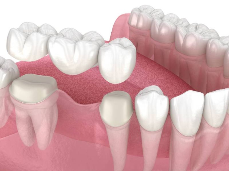 prótesis fija dental