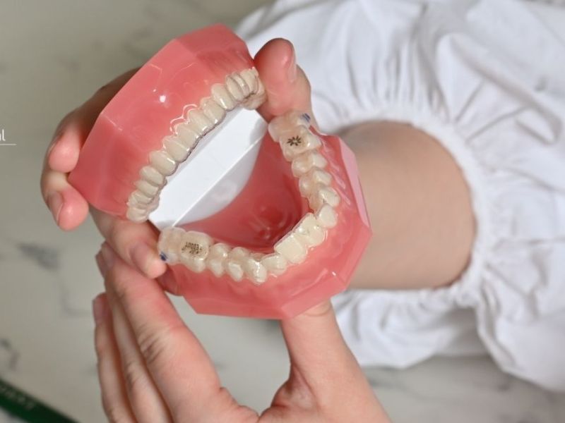 fixed dental prosthesis