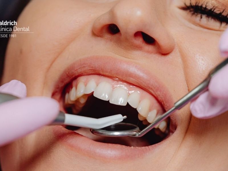 what is dental cleaning