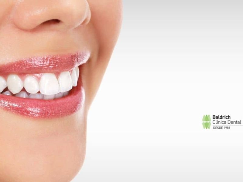 blanqueamiento dental
