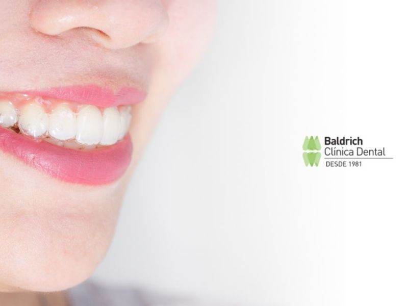 estética dental Invisalign