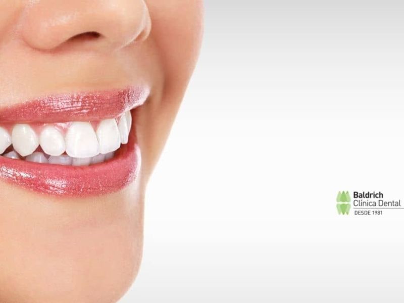 tooth whitening