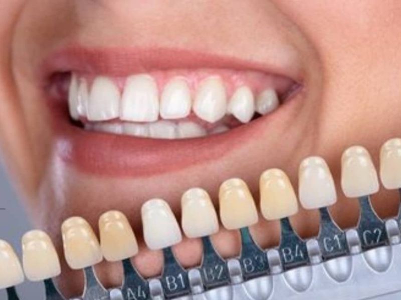 porcelain veneers