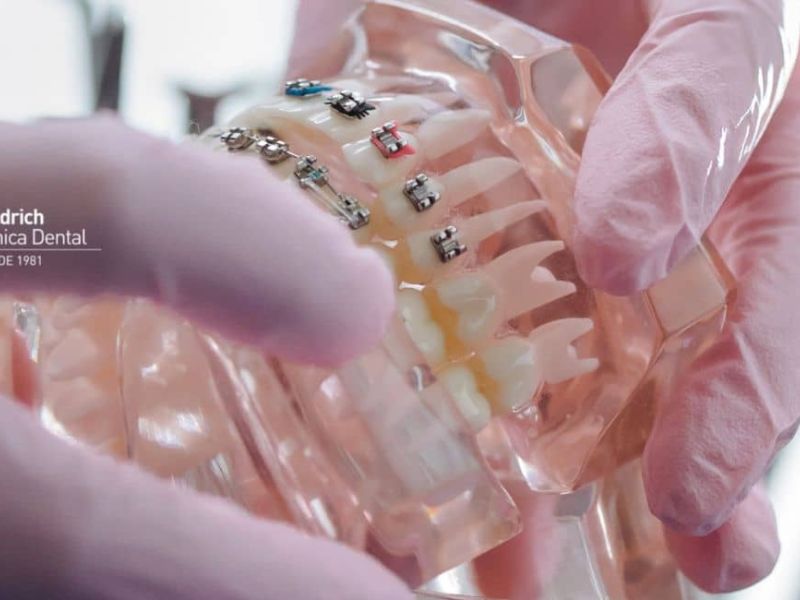 tipos de prótesis dentales