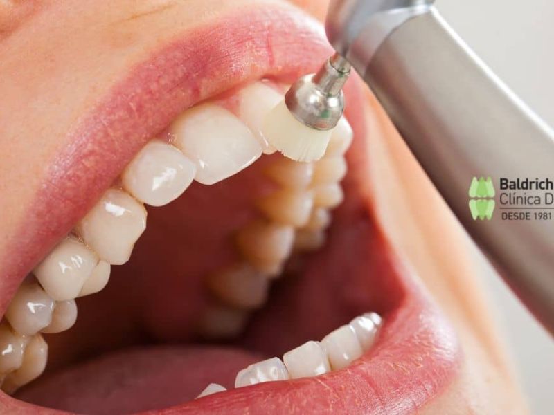 frecuencia limpieza dental