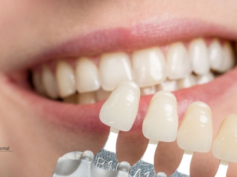 carillas dentales